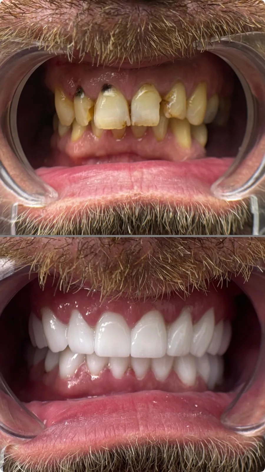 Caso prima e dopo di riabilitazione con impianti dentali e corone in zirconia