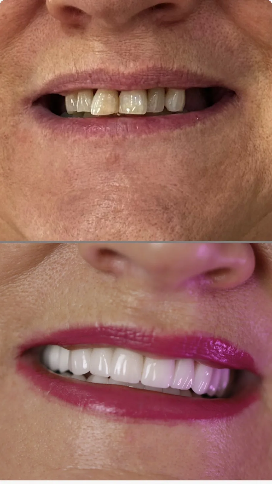 Prima e dopo corone dentali in zirconia su denti anteriori