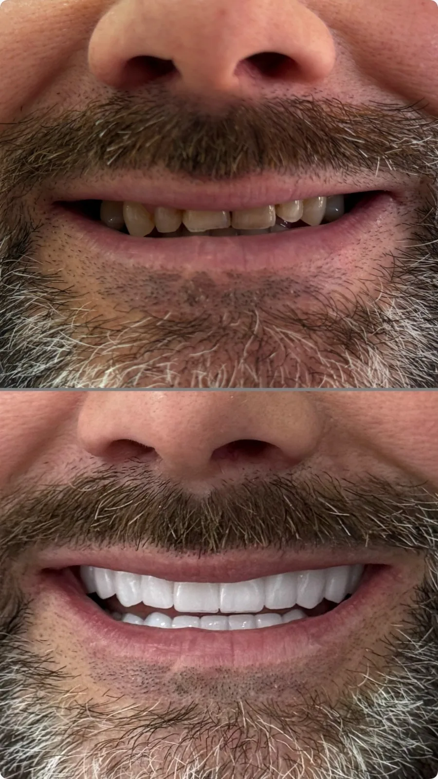 Prima e dopo riabilitazione dentale All-on-4