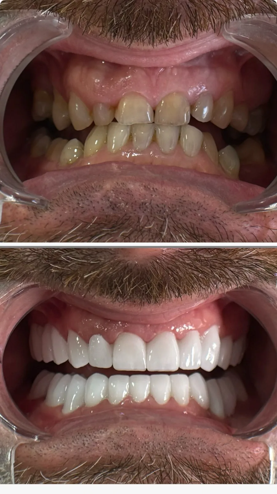 Sostituzione di corone datate con corone in ceramica di nuova generazione.