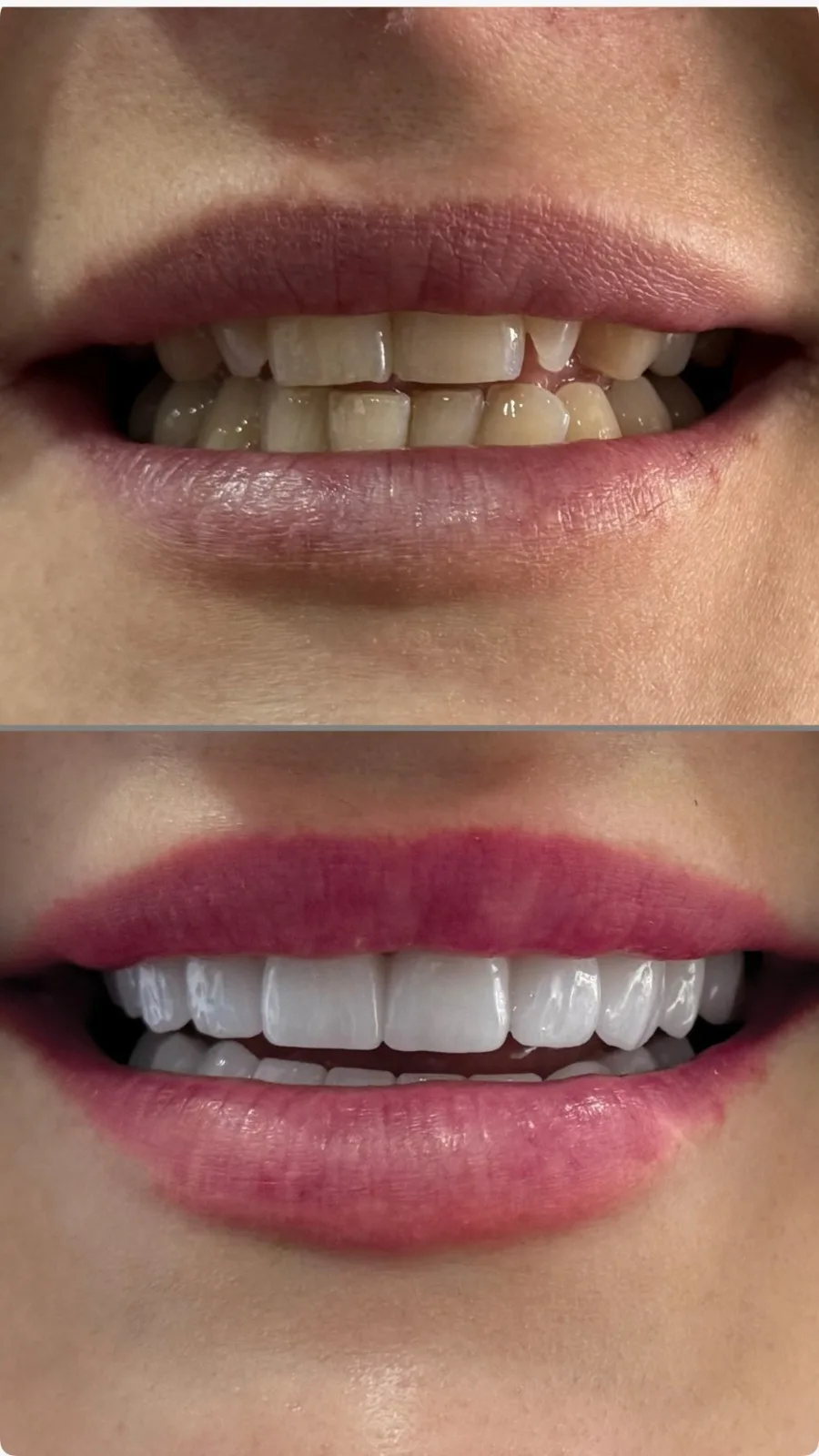 Risultato finale di una riabilitazione estesa con corone in zirconia.